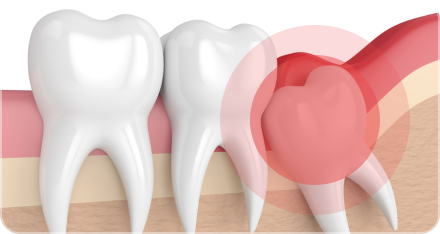 Воспаление зубов (десен)