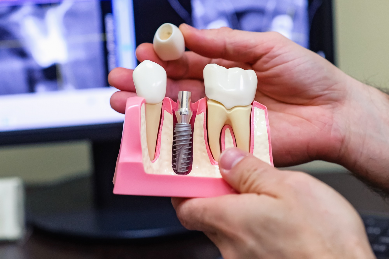 Когда можно делать имплантацию после удаления или утраты зуба?