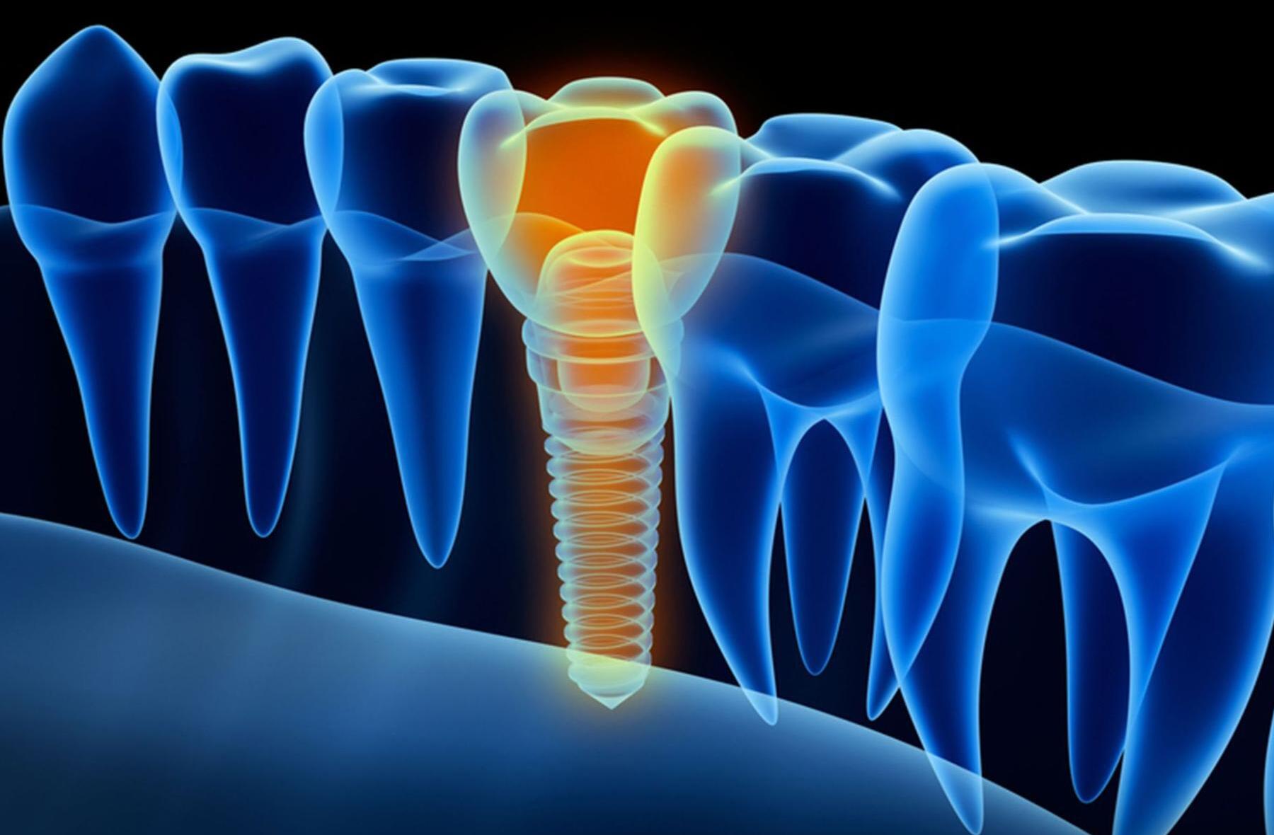 Зубная имплантация при Гипотиреозе, Гипертиреозе, АИТ и узлах Щитовидной железы?