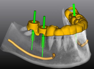 Компьютерное 3D моделирование имплантации зубов