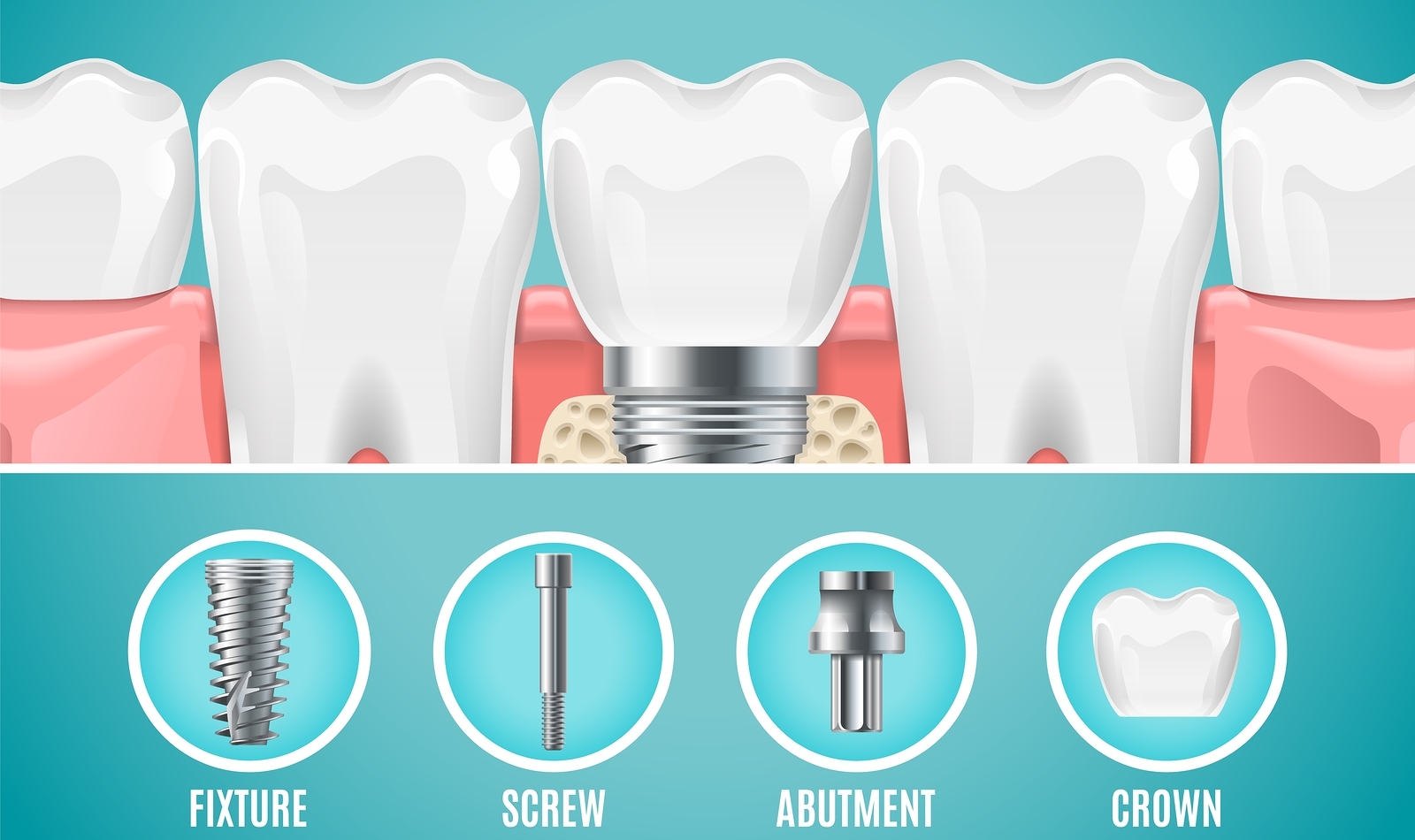 Что такое абатмент в стоматологии?