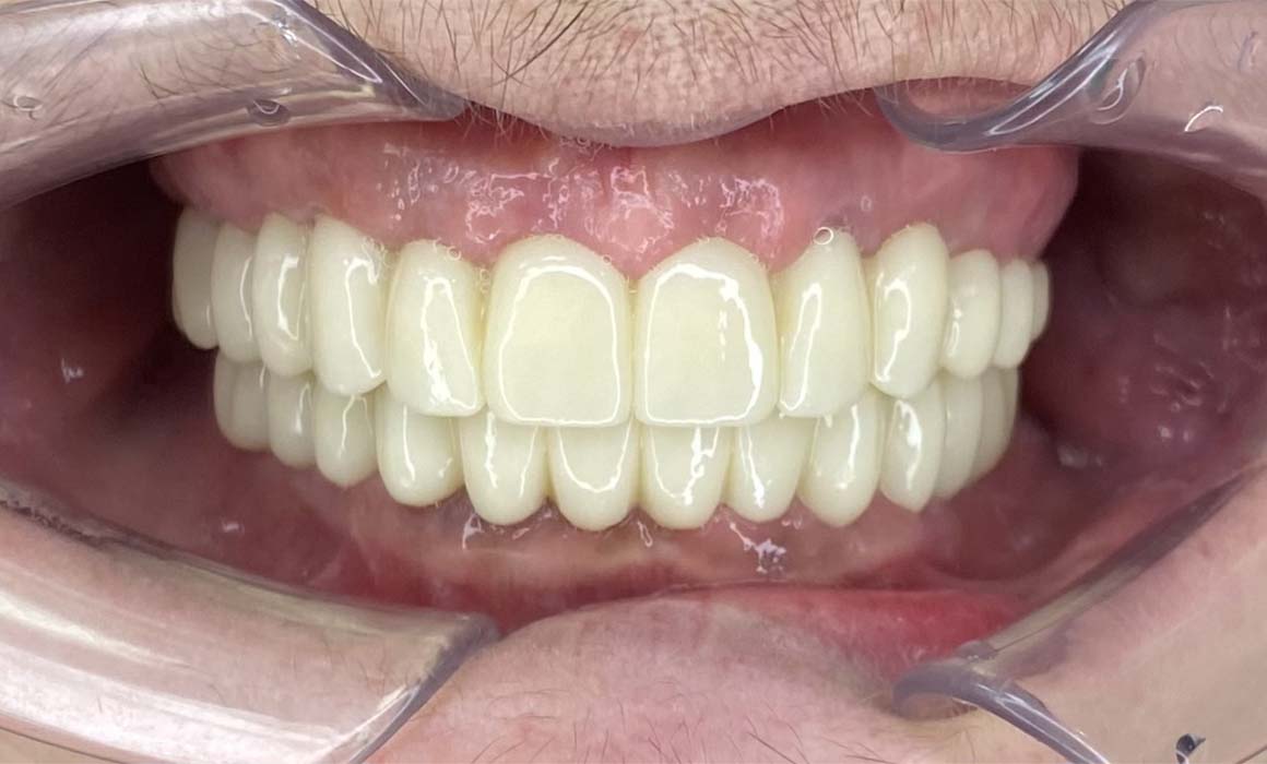 Кейс восстановления зубов при пародонтите