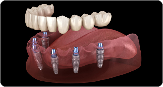 Как происходит протезирование зубов – все этапы работ