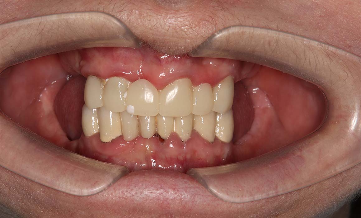 Пример имплантации при потере жевательных зубов