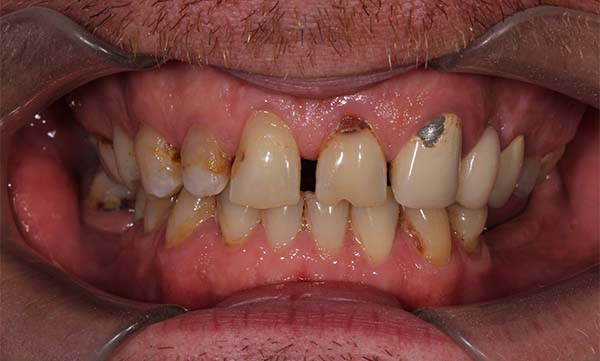 Лечение зубов и установка имплантов