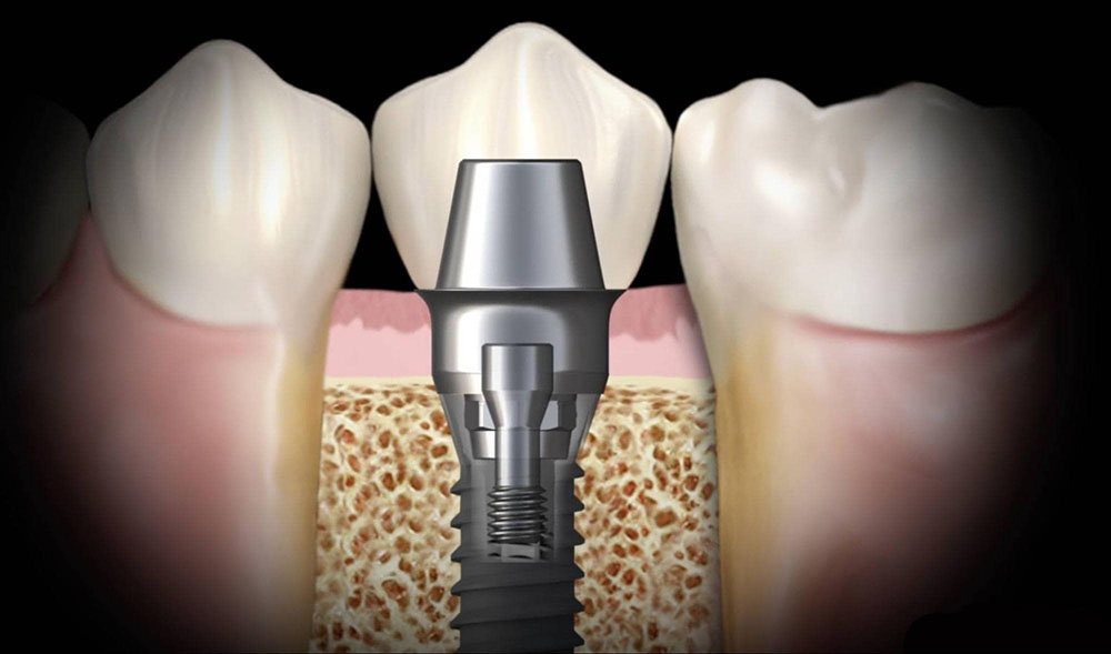 Через сколько снимают швы после имплантации зуба?