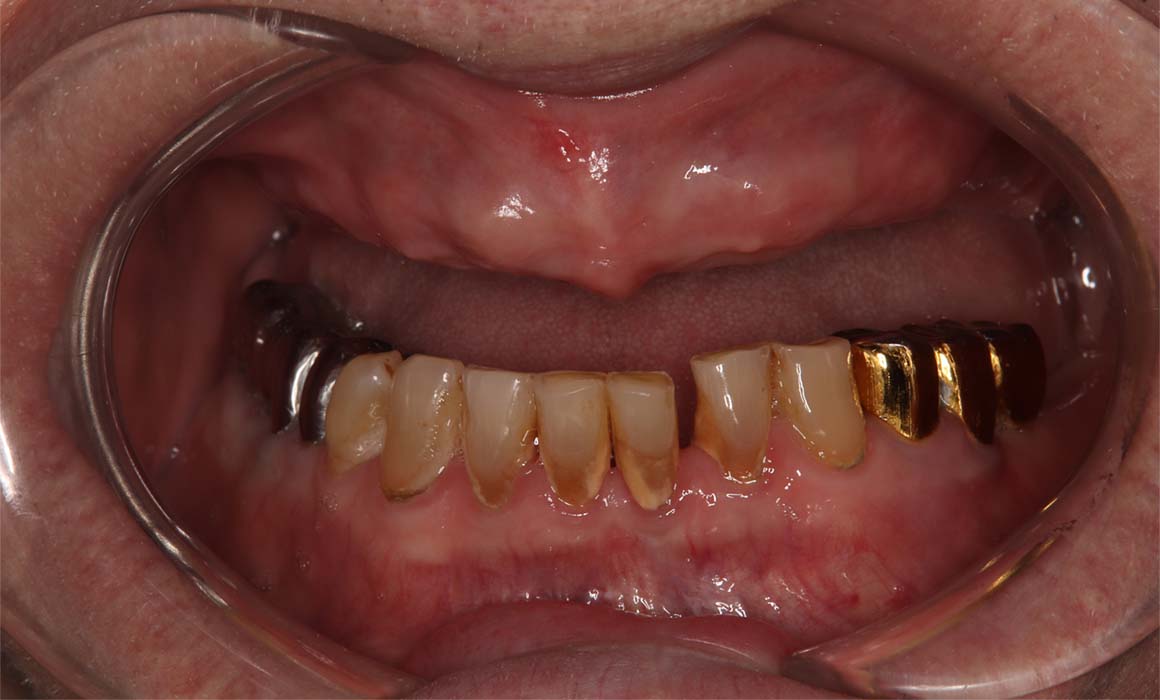 All-on-6 имплантация зубов верхней челюсти