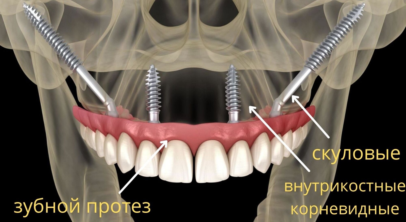 Типы фиксации импалнтов в челюсти