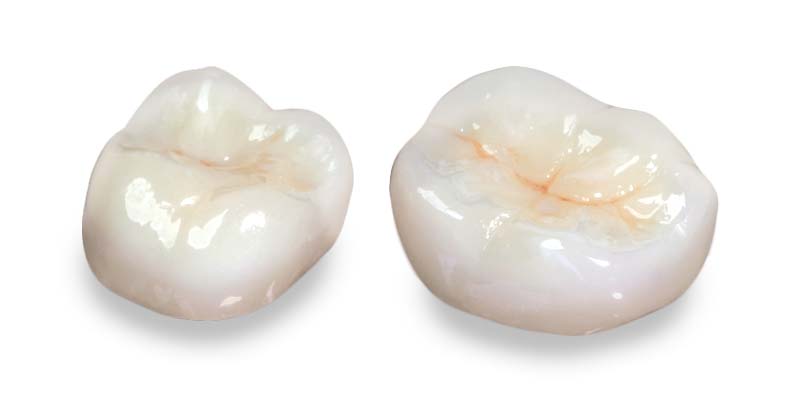 Коронки из диоксида циркония для жевательных зубов