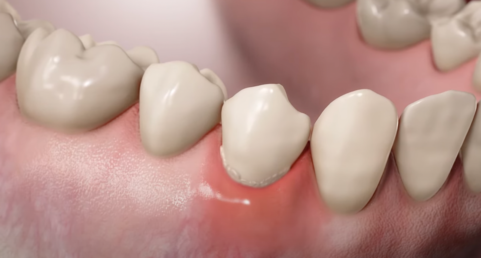 Воспаление соседних зубов от имплантата