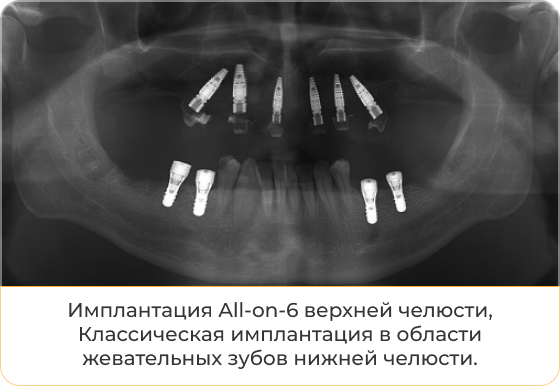 Слева - фото после имплантации по протоколам All-on-6/4 - для верхней и нижней челюстей соответственно